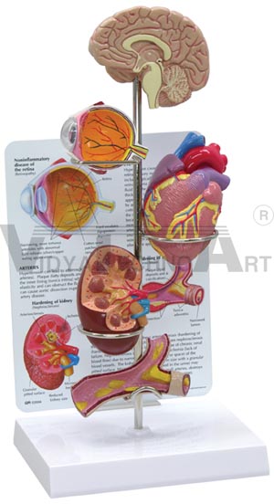 Hypertension Model Set